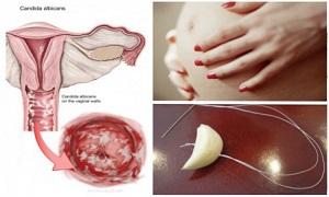 Candidiasis Treatment