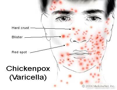 Chicken Pox