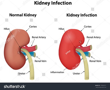Kidney Stones